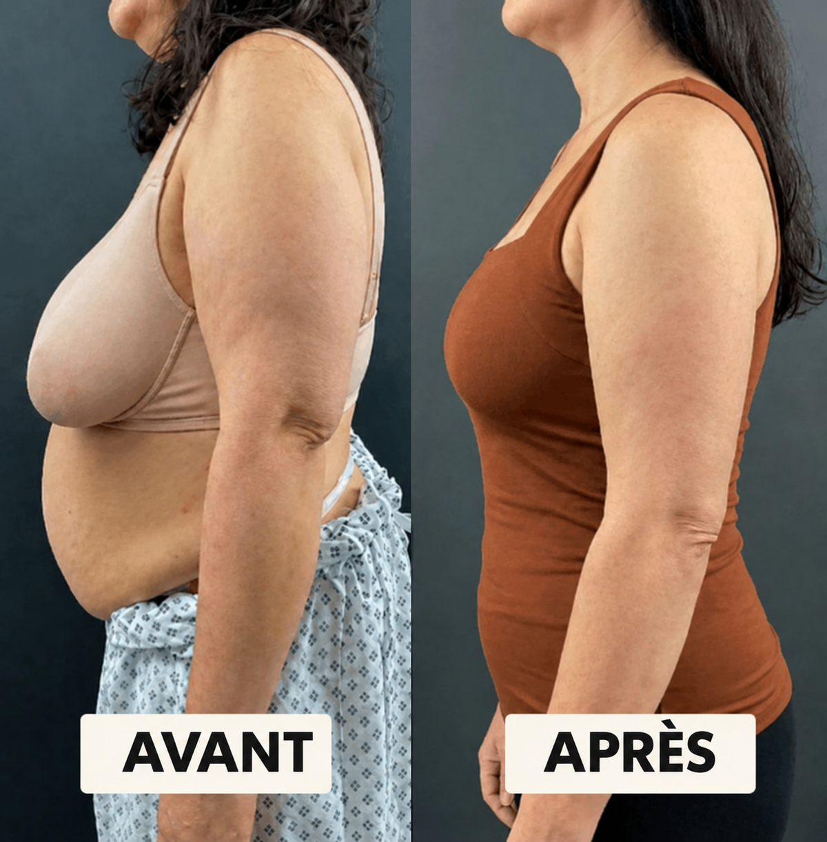 Avant / après – profil